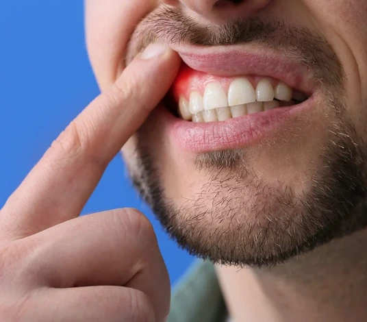 علاج التهاب اللثة بعد حشو الضرس