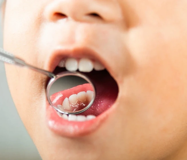 علاج التسوس البسيط